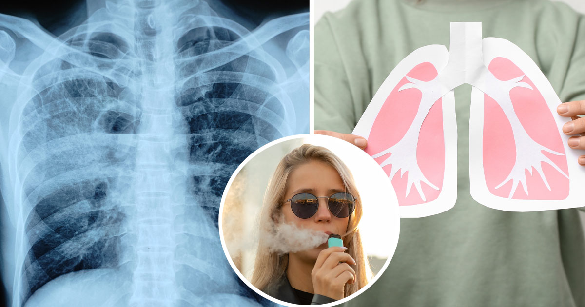 22-year-old diagnosed with lung cancer linked to vaping warns of 1 key ...