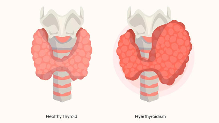 Thyroid and heart disease: What happens when both conditions coexist?