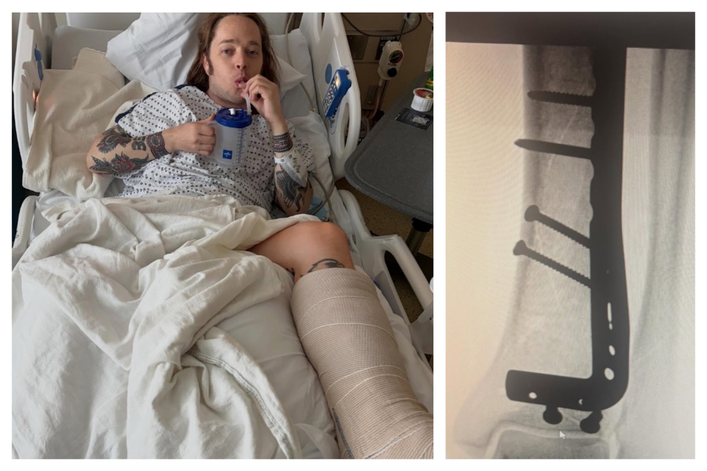 Billy Strings breaks leg skateboarding backstage, posts grisly X-rays