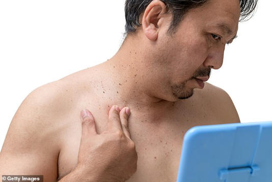 Too much insulin triggers skin tags. The body overproduces the hormone when cells stop responding properly and that excess directly stimulates skin cell growth (stock)