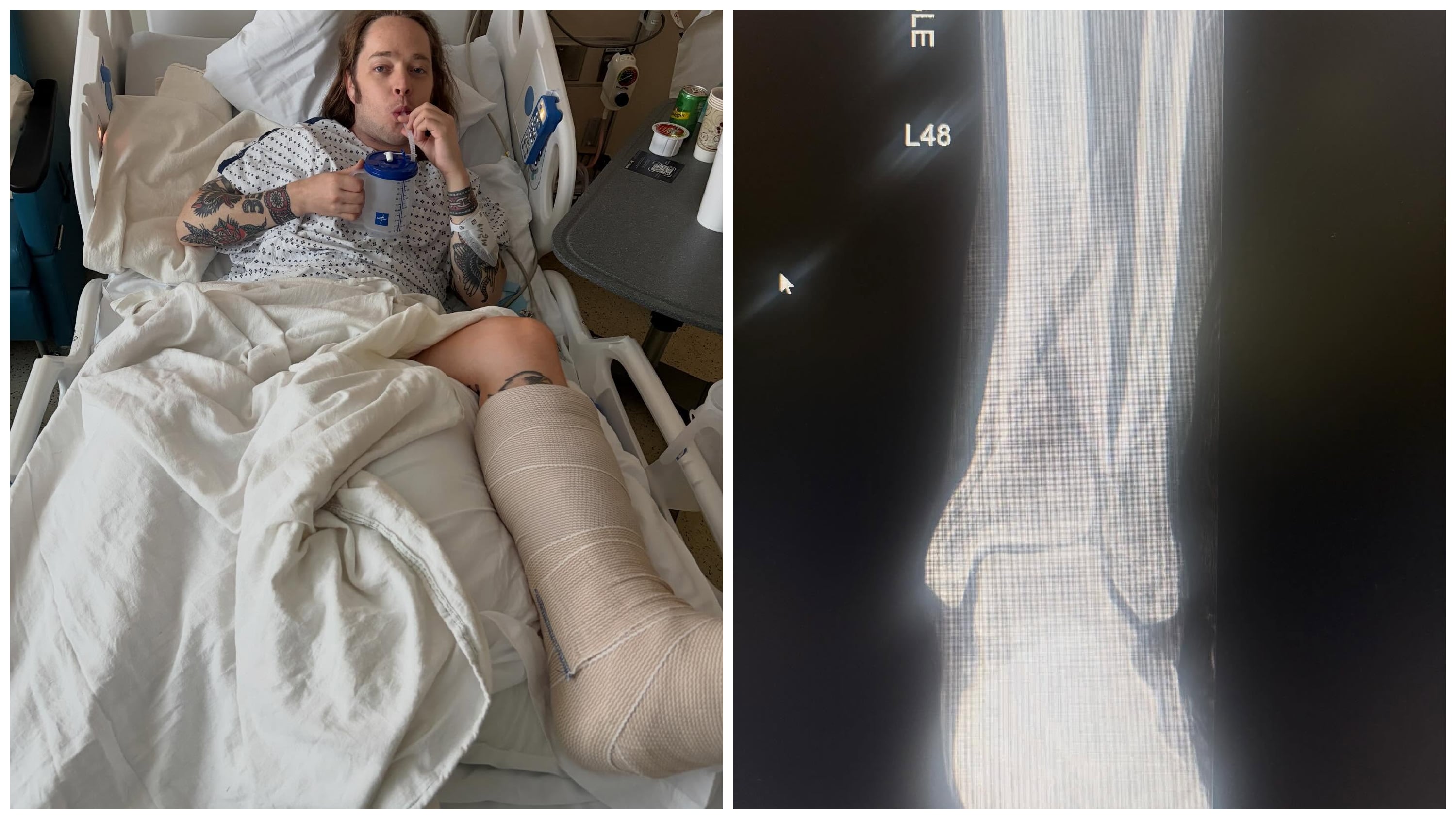 Grammy winner reveals horrific injury from backstage accident