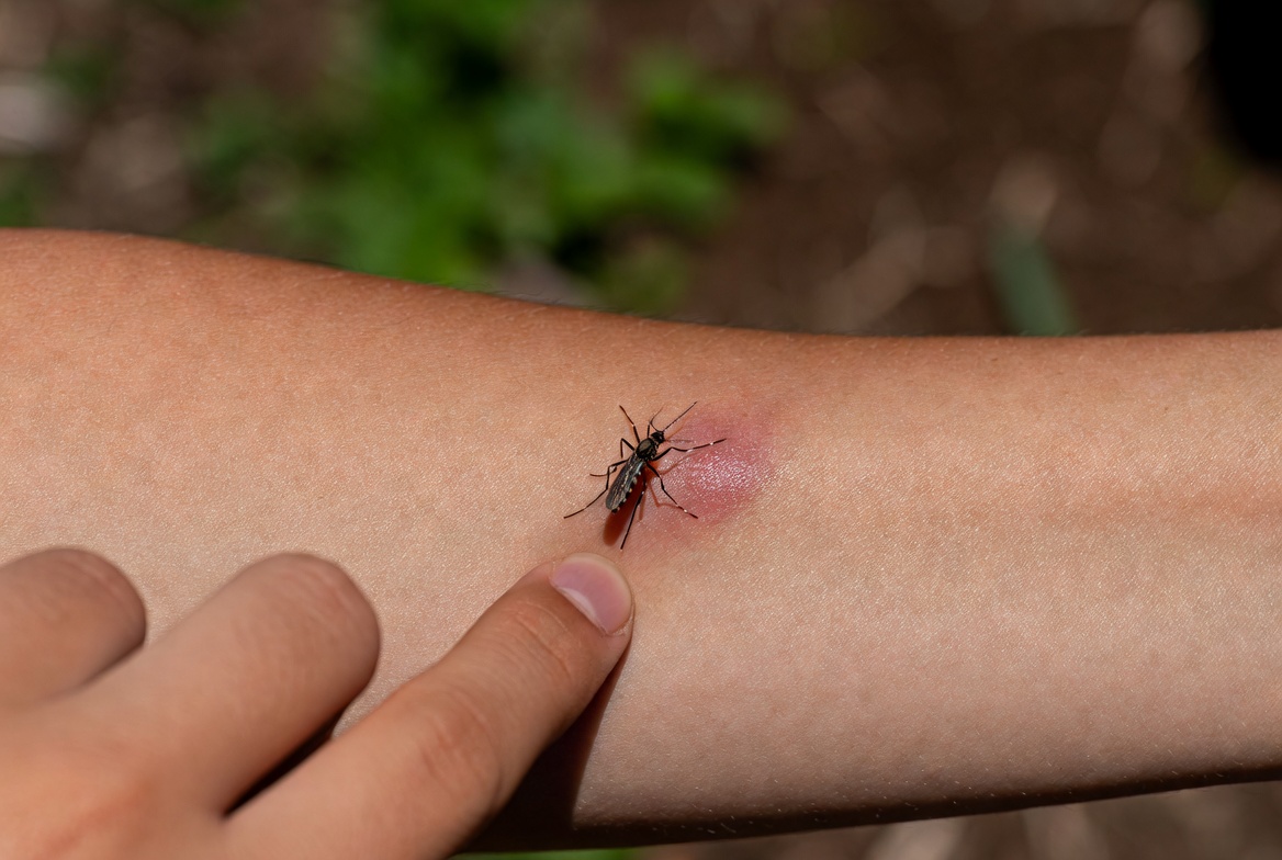Morso di zanzara: come alleviare il prurito in modo efficace