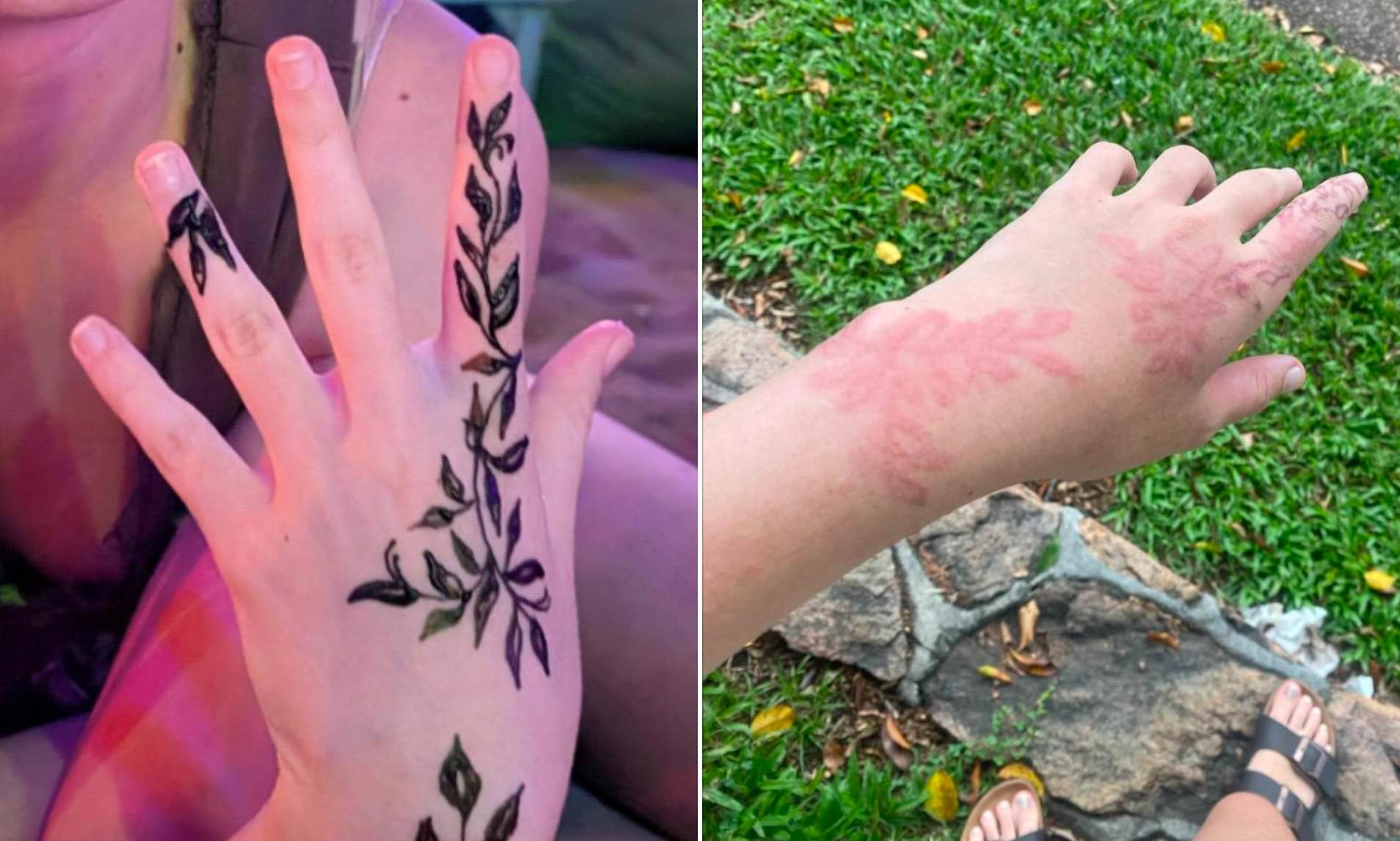 Bali mistake could leave young Aussie girl scarred for life - as mum ...