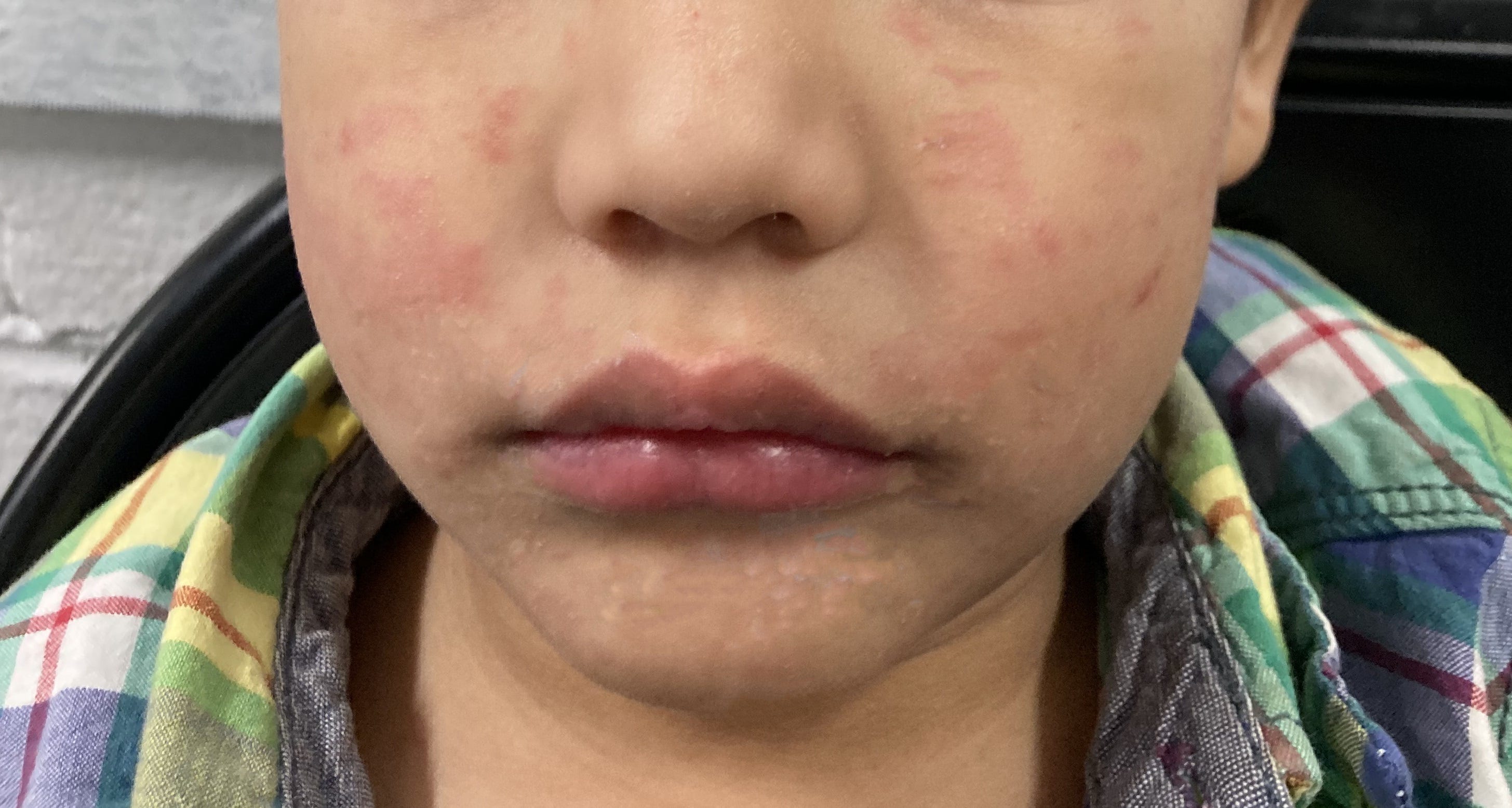 As measles cases rage in Florida, vaccine resistance persists. Why?