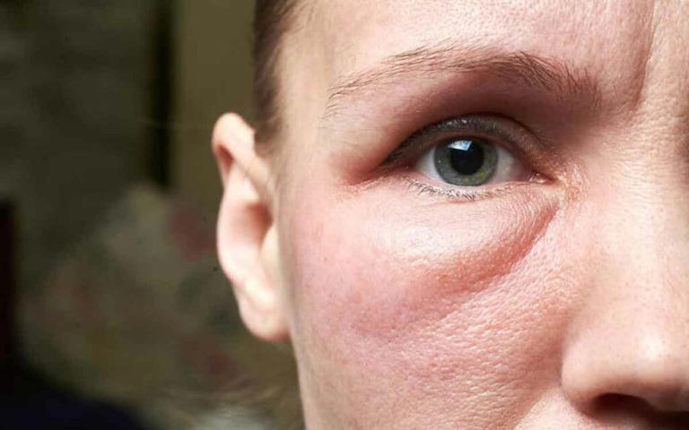 Face Inflammation | ముఖంలో వాపులు వ‌చ్చి అంద‌విహీనంగా క‌నిపిస్తుందా ...