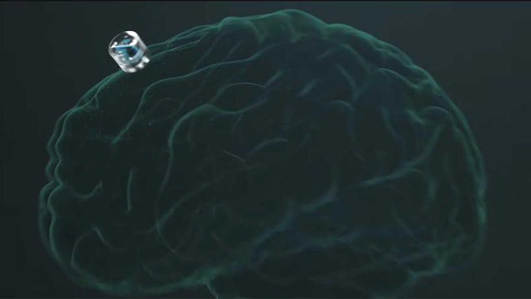 FDA clears first US trial of Motif’s wireless brain implant for depression