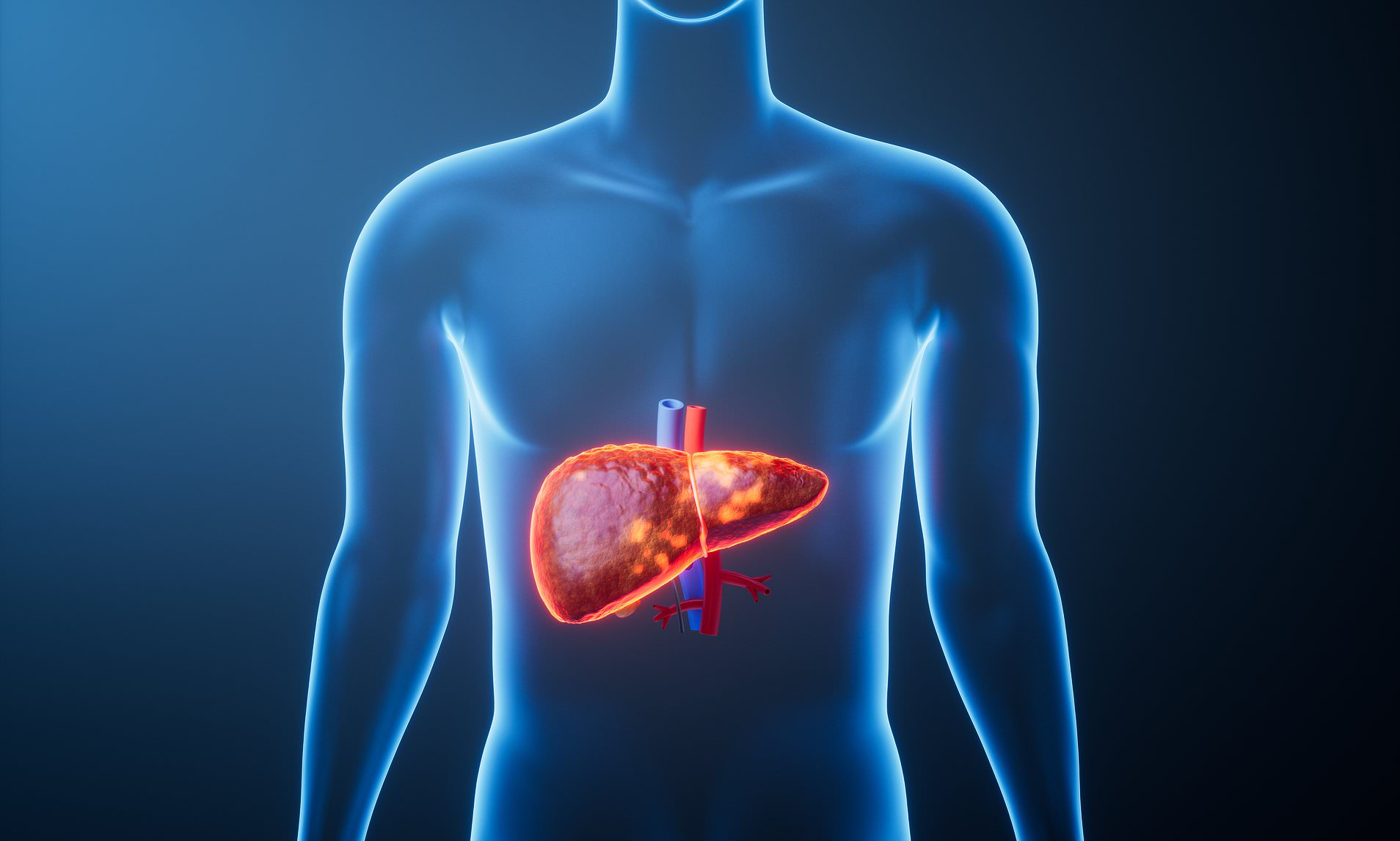Millions at risk of deadly liver disease - but experts say lifestyle ...