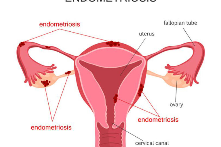 Lesser known signs of endometriosis as new test for early diagnosis ...