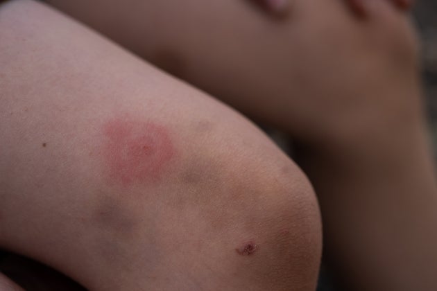 It's tick season – if they end up on you or your kids, this is how to ...