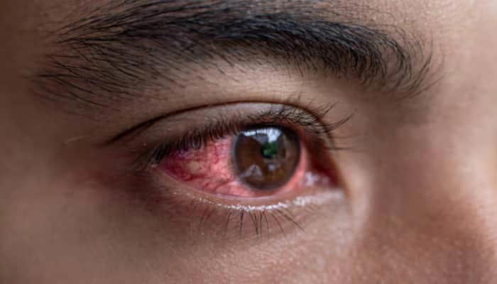 What causes swimming pool eye infection? Expert reveals symptoms, cure ...