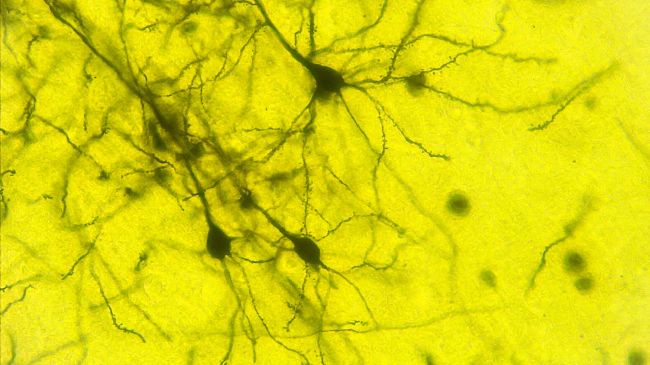 A $2 amino acid supplement slashed Alzheimer’s brain plaque in every ...