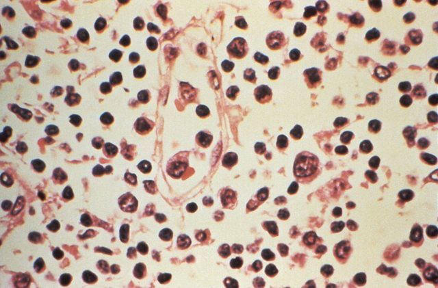 WHO warns of more hantavirus cases in 'limited' outbreak