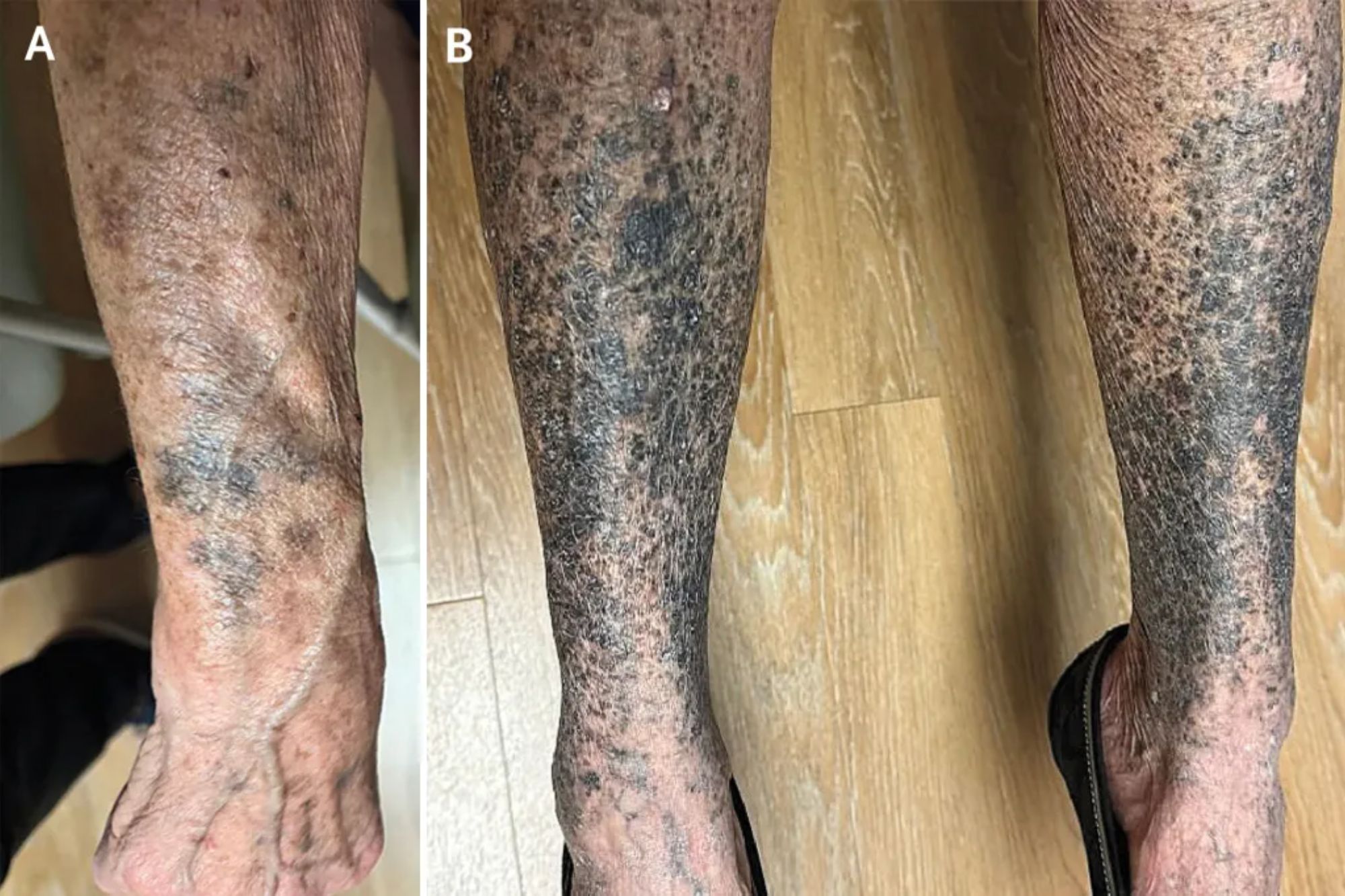 68-year-old woman’s arms and legs turn blue after taking very common drug
