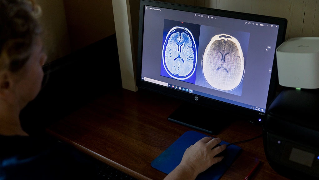 Study links brain artery widening to common stroke type