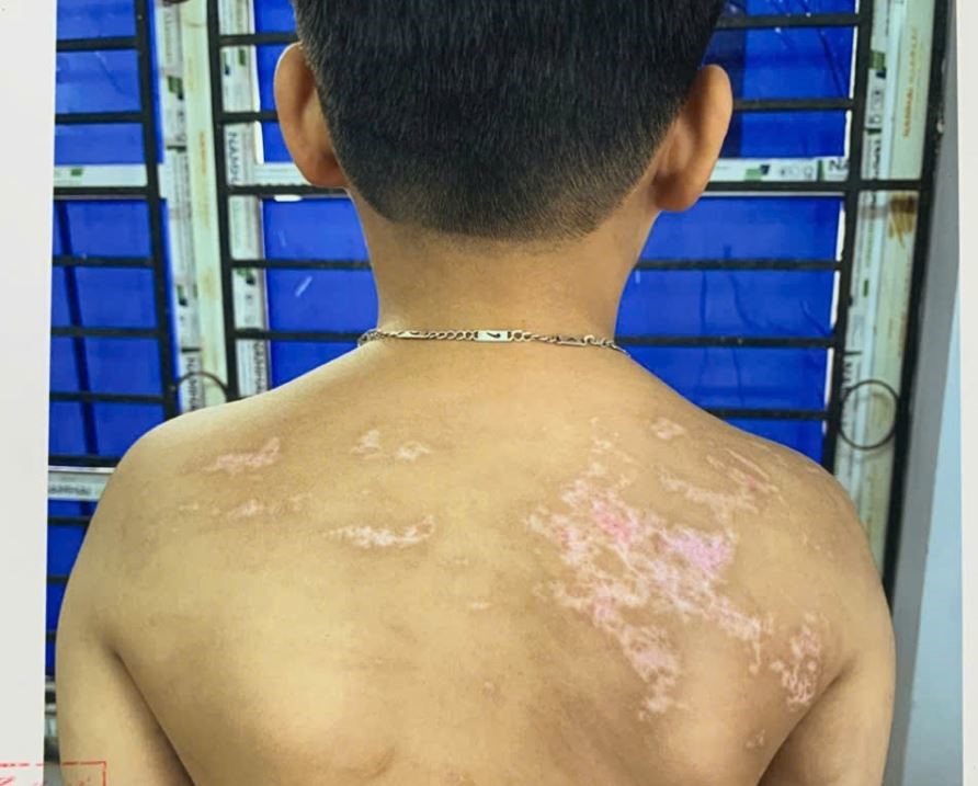 Bắt tạm giam người cha bạo hành con trai hơn 7 tuổi ở Phú Thọ