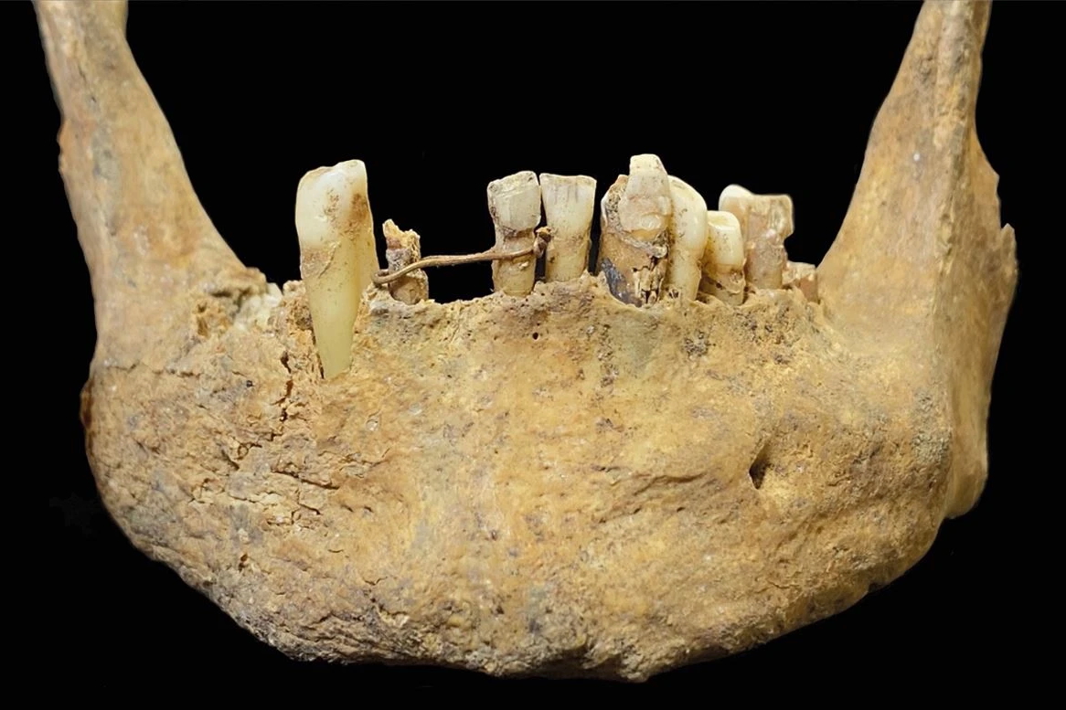 Why did this wealthy Scotsman pay a jeweler to wrap his teeth in gold ...