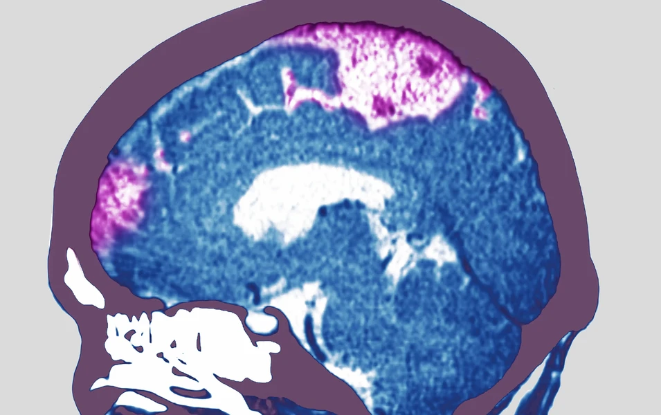 Study links brain artery widening to common stroke type