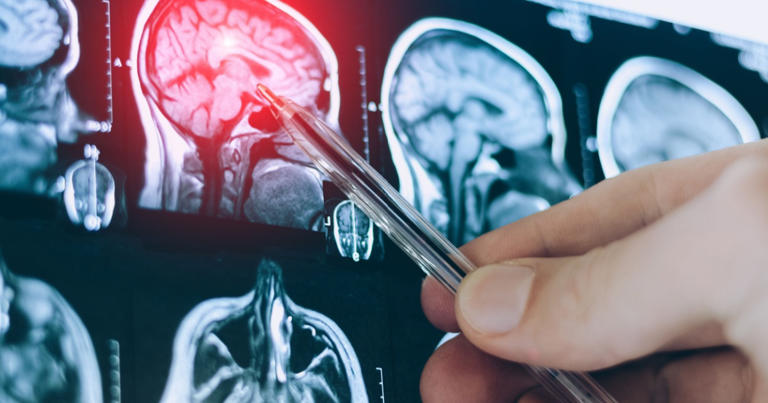 New brain-based cause of high blood pressure discovered