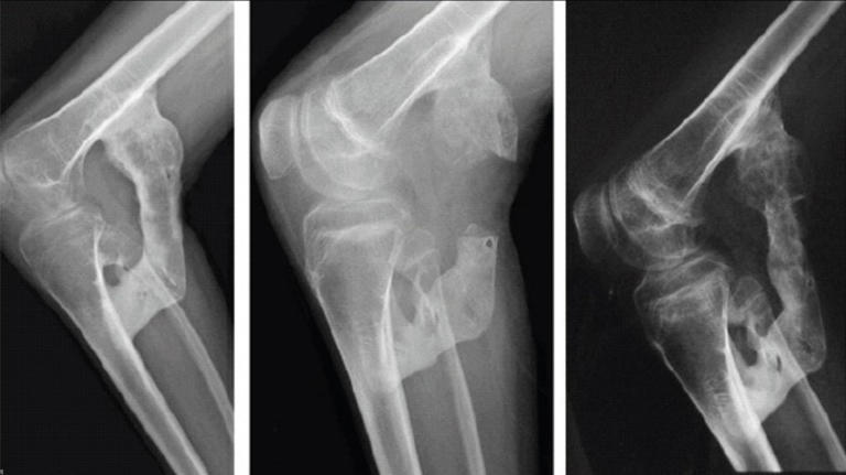 Science explains the rare disease that slowly turns its victims to stone