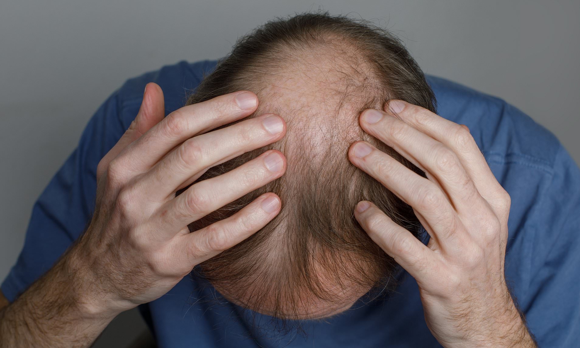 Health chiefs issue urgent safety warning over common hair loss pills ...