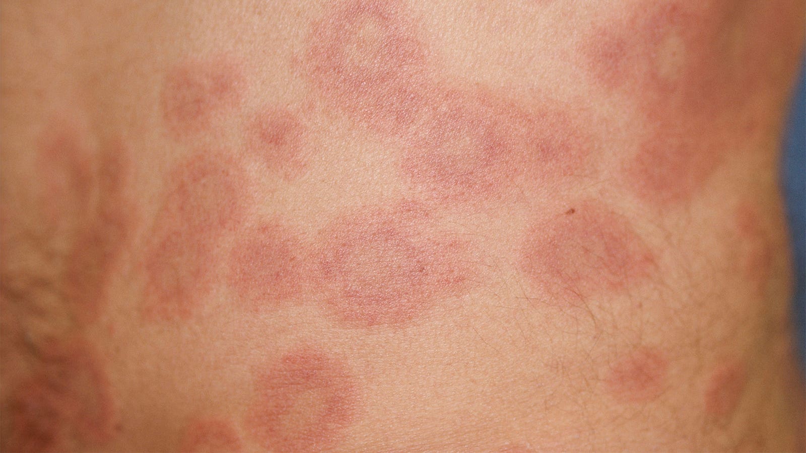 Drug targeting TLRs in cutaneous lupus looks good in mid-stage studies