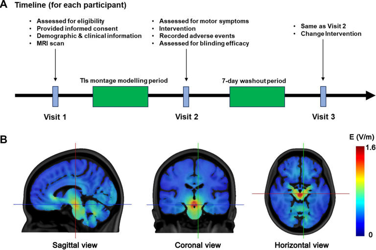 Noninvasive deep brain stimulation technique shows early promise