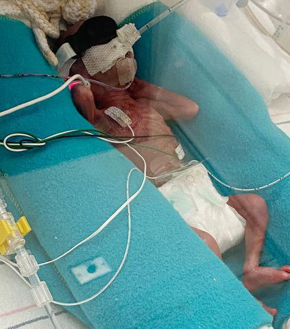 Baby born at 23 weeks officially graduates from NICU after being given ...