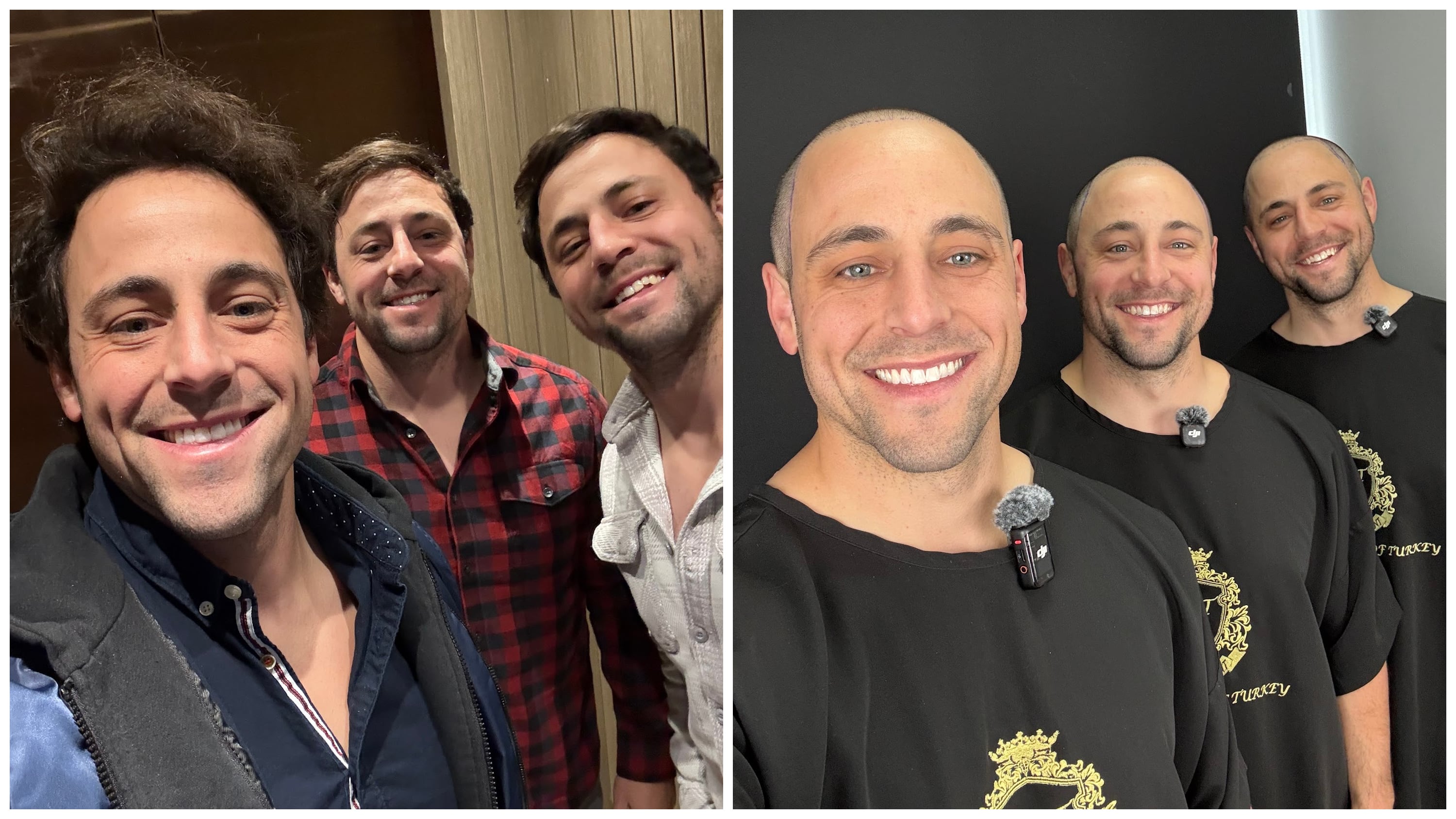 Identical triplets reveal their matching hair transplants