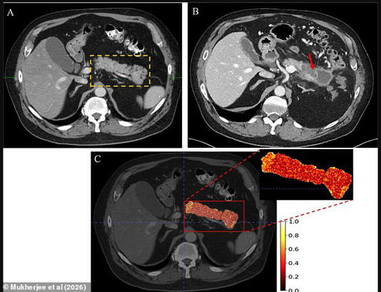 Panel A shows a CT scan of a 63-year-old man, which was interpreted as normal, with the pancreas outlined (yellow dashes). Panel B shows a CT scan from the same patient 2.4 years later with the red arrow pointing to a large pancreatic ductal adenocarcinoma (cancer). Lastly, panel C shows texturized maps generated by the REDMOD AI tool. The color map indicates that areas of high feature expression (red/yellow) are concentrated in the region of the pancreas where the tumor subsequently developed