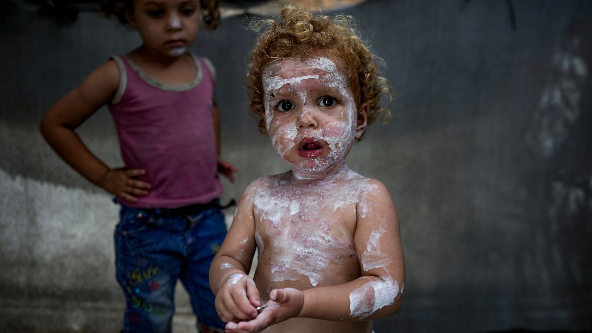 Skin diseases surge in Gaza’s overcrowded displacement camps