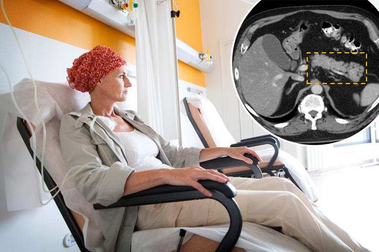 New tool can find deadliest cancer years before tumors can be seen on a ...