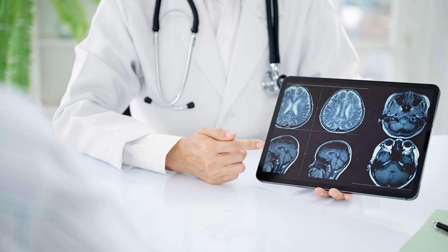 MS and seizures: What you need to know