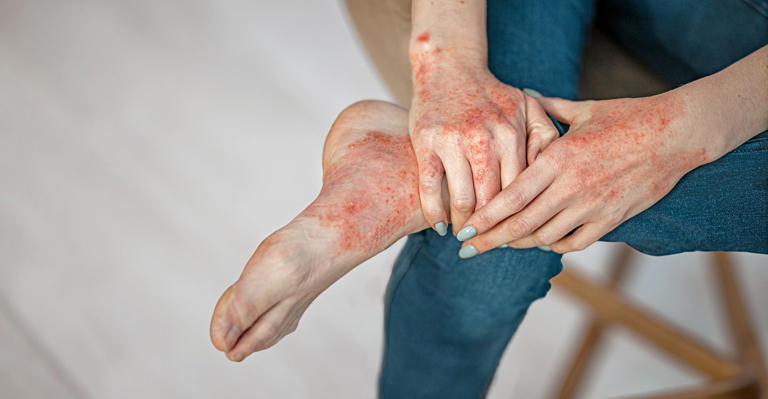 How to build a smart skin-care routine when managing eczema