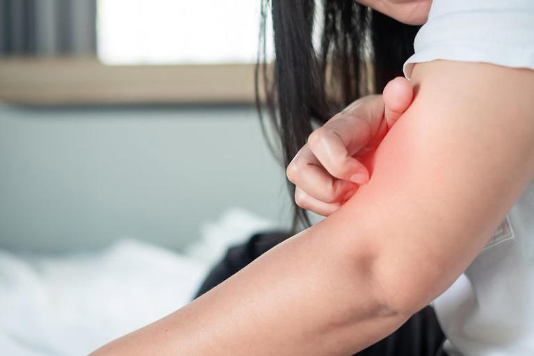 DWP confirms full list of 24 skin conditions that qualify for £114 ...