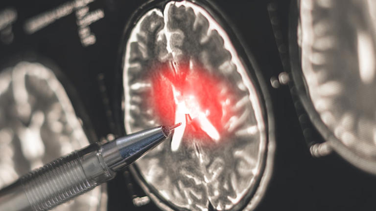 Women face much higher MS risk. A new discovery may help explain why.