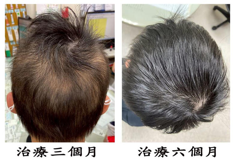 10歲女童快禿了「頭髮掉8成」! 嚇到不敢上學 3年逆轉全長回來