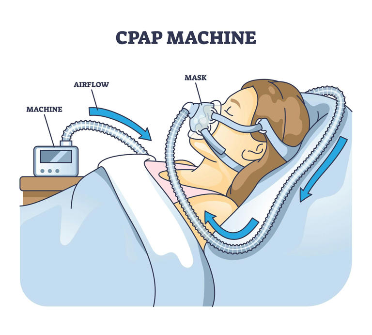 Sleep apnea compromises far more than a good night’s rest – 2 ...
