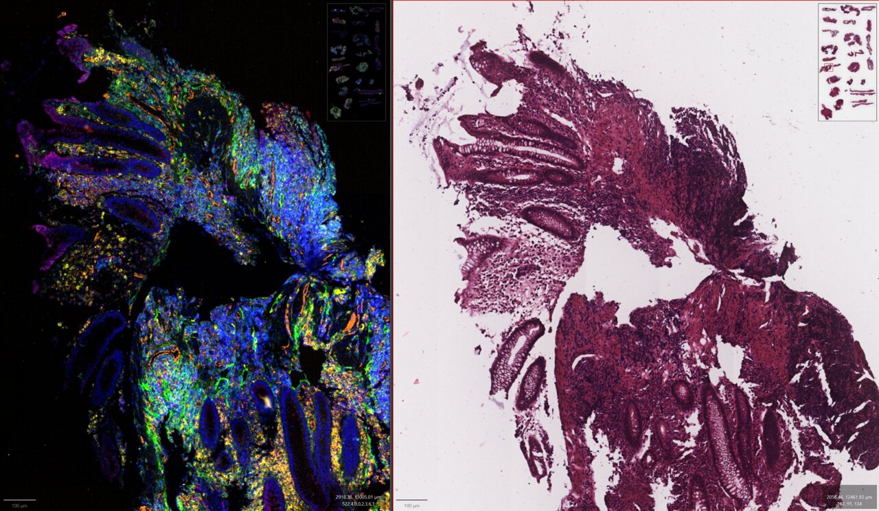 AI screening tool gives pathologists 'spatial super-vision' to detect ...