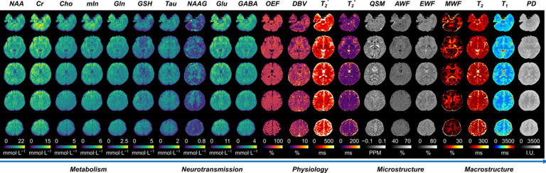 New MRI technology maps 20-plus brain biomarkers in a single 14-minute scan