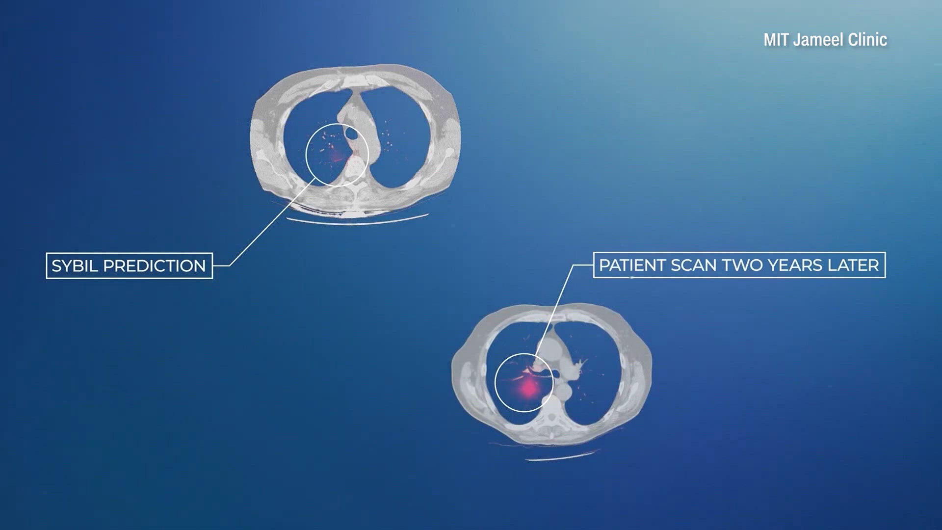 New AI tool can predict lung cancer up to 6 years before diagnosis ...
