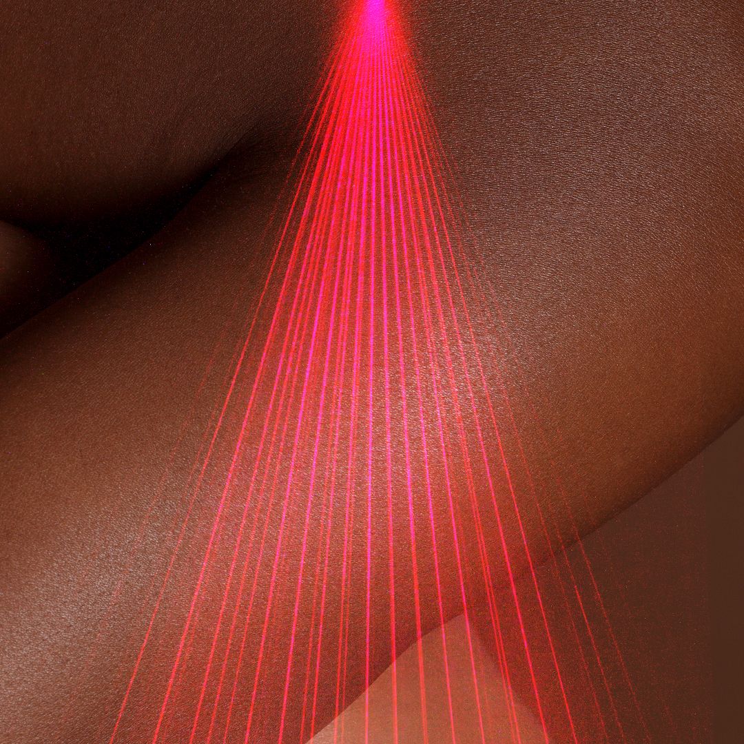Dermatologists reveal the gold standard laser for melanin-rich skin