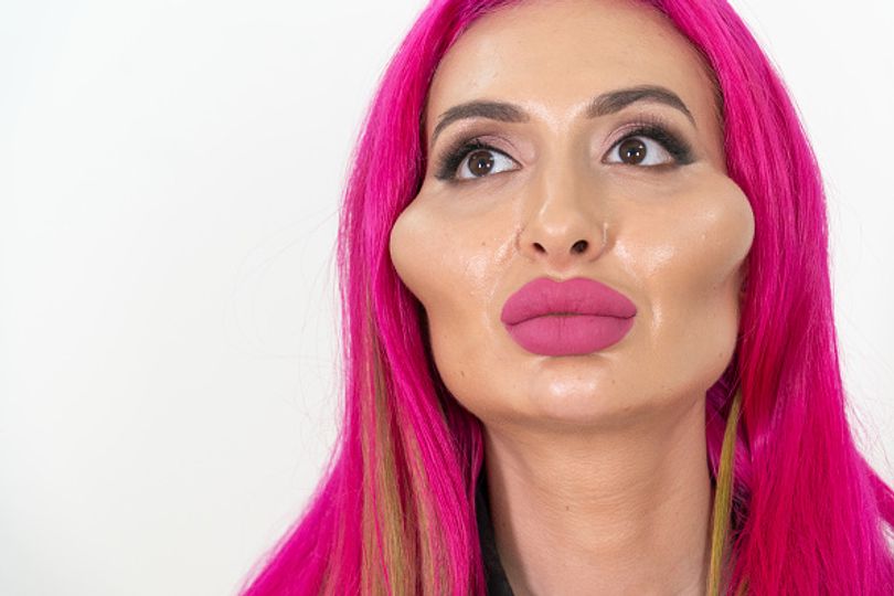 Model with 'world's biggest cheeks' is getting filler dissolved after ...