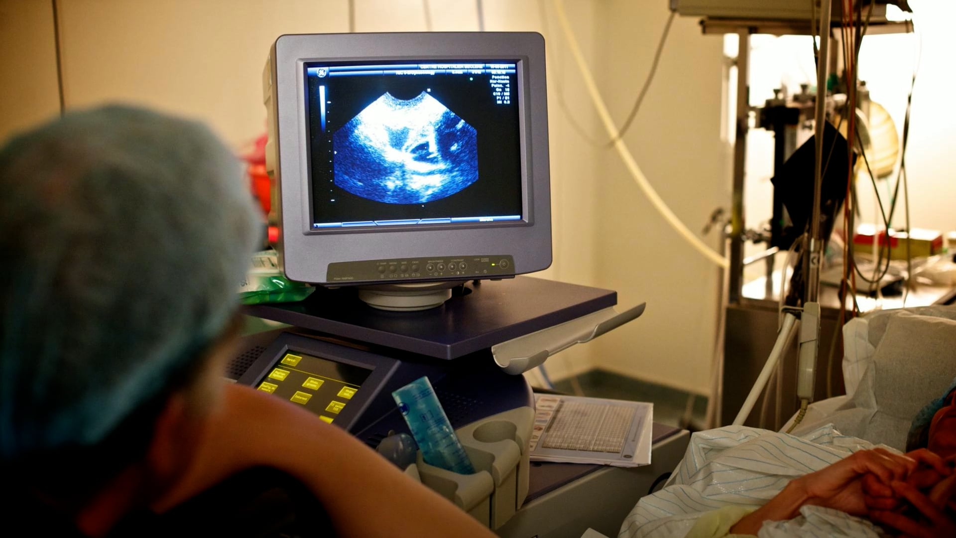 PCOS renamed in bid to improve care for millions of women