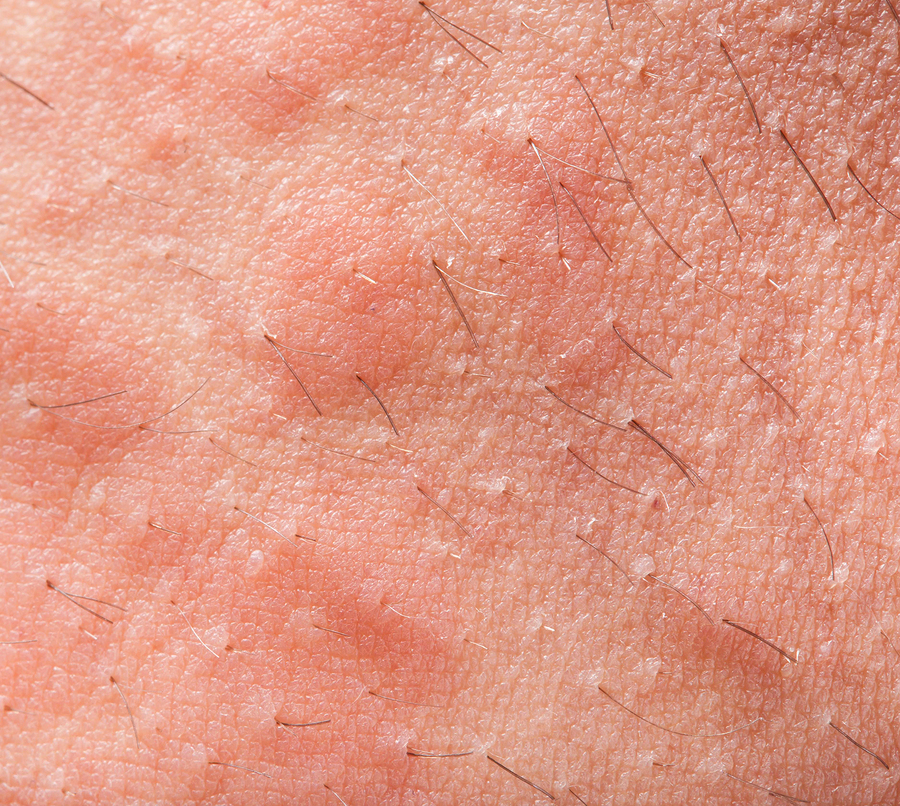 Common rashes and what they really mean—some are more serious than they ...