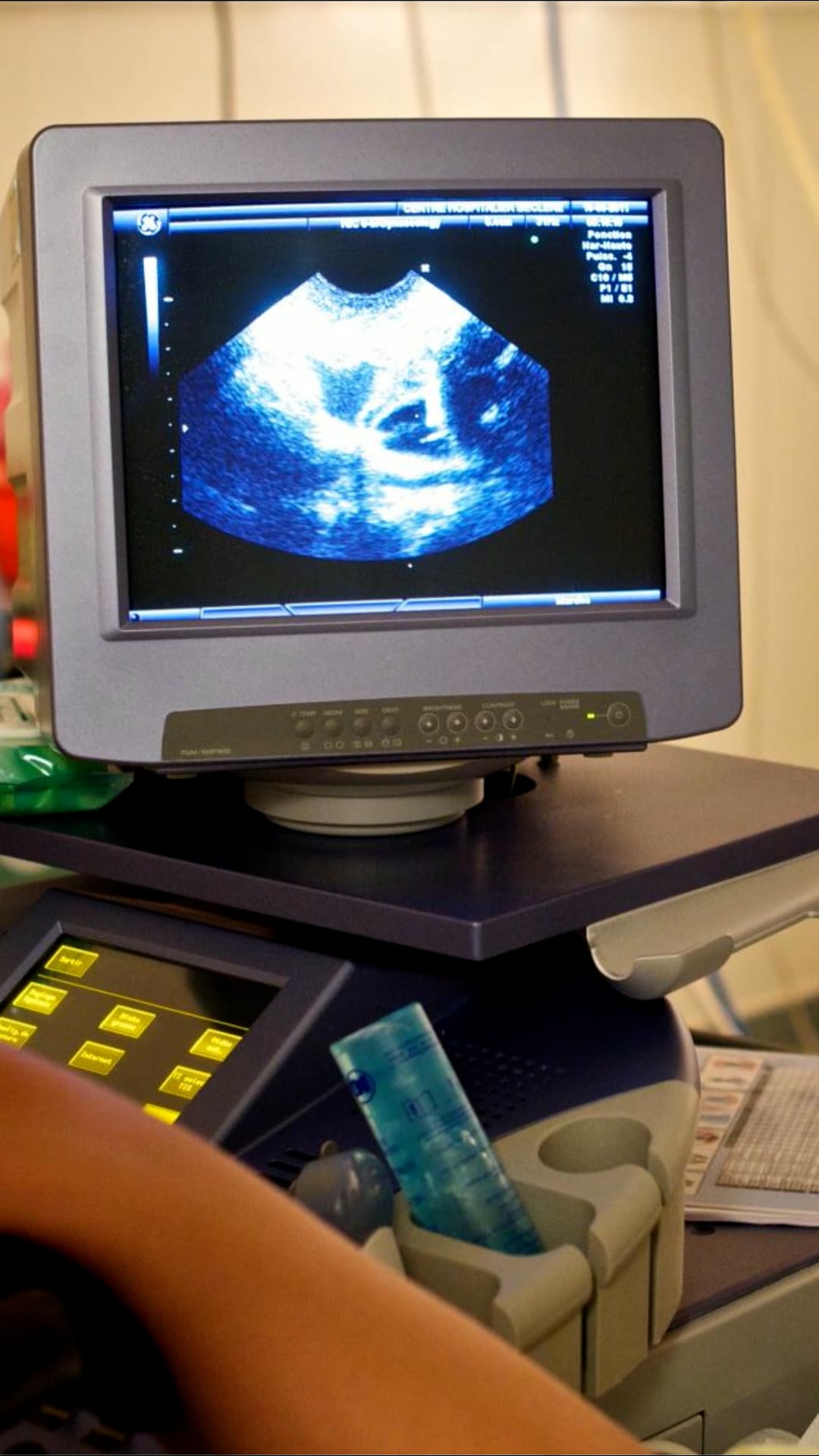 PCOS renamed in effort to improve care for millions of women