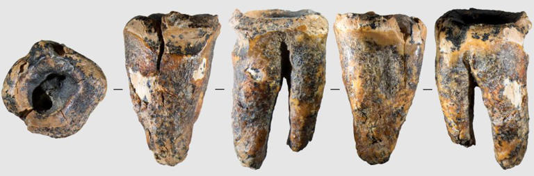 Tooth shows cavemen conducted dental surgery before anesthesia