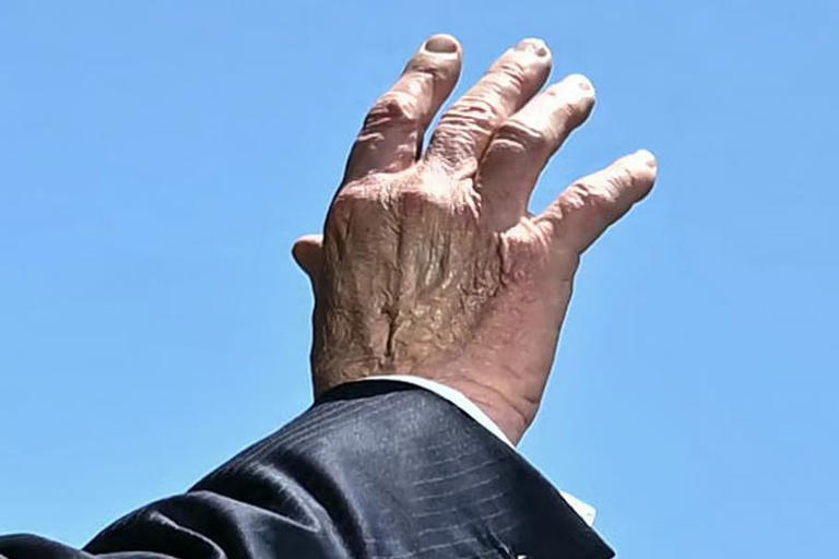 Worries about RFK Jr.'s health soar as his hands are captured next to ...