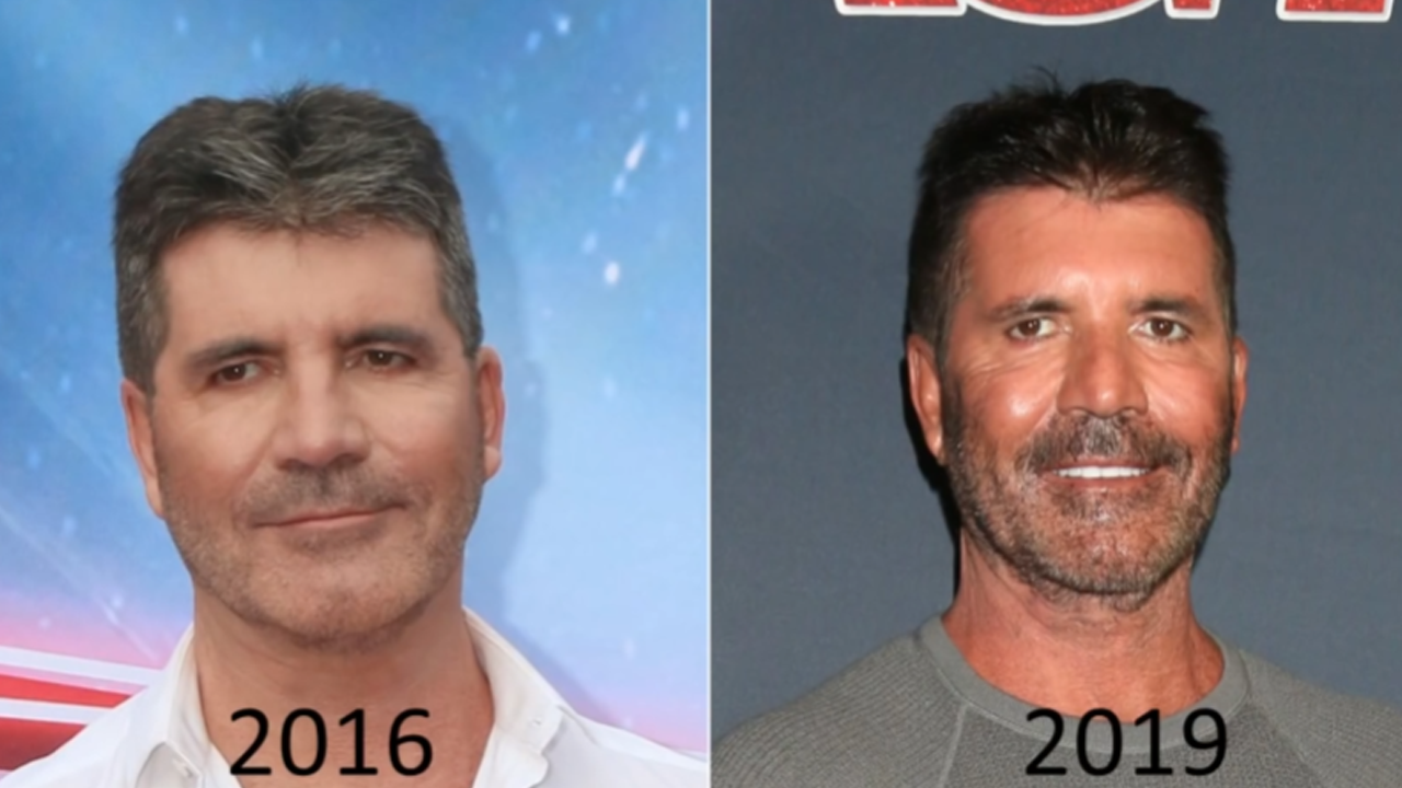Plastic surgeon analyzes Simon Cowell’s transformation