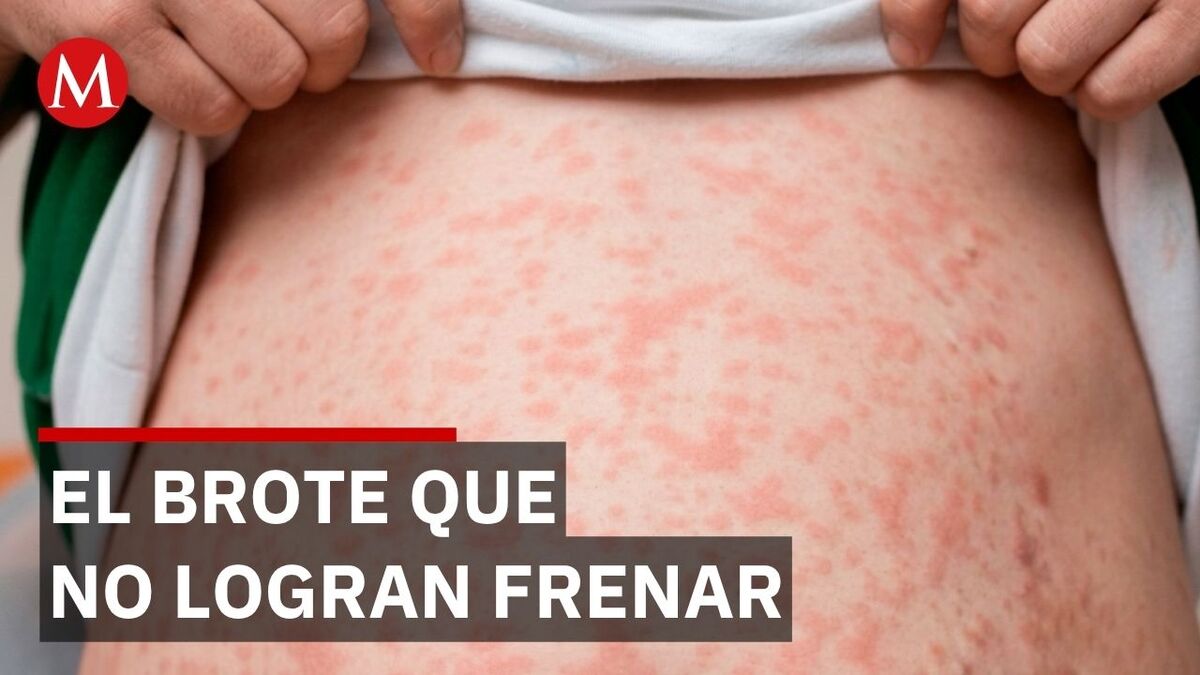 Alerta sanitaria en México: los contagios de sarampión se disparan a ...