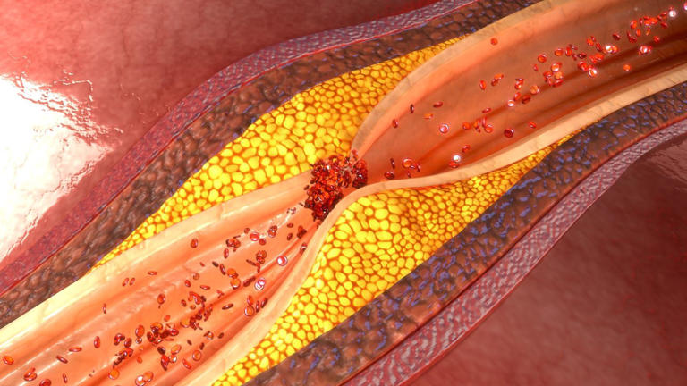 Cagent Vascular raises $41M for dual-modality IVL platform advancement